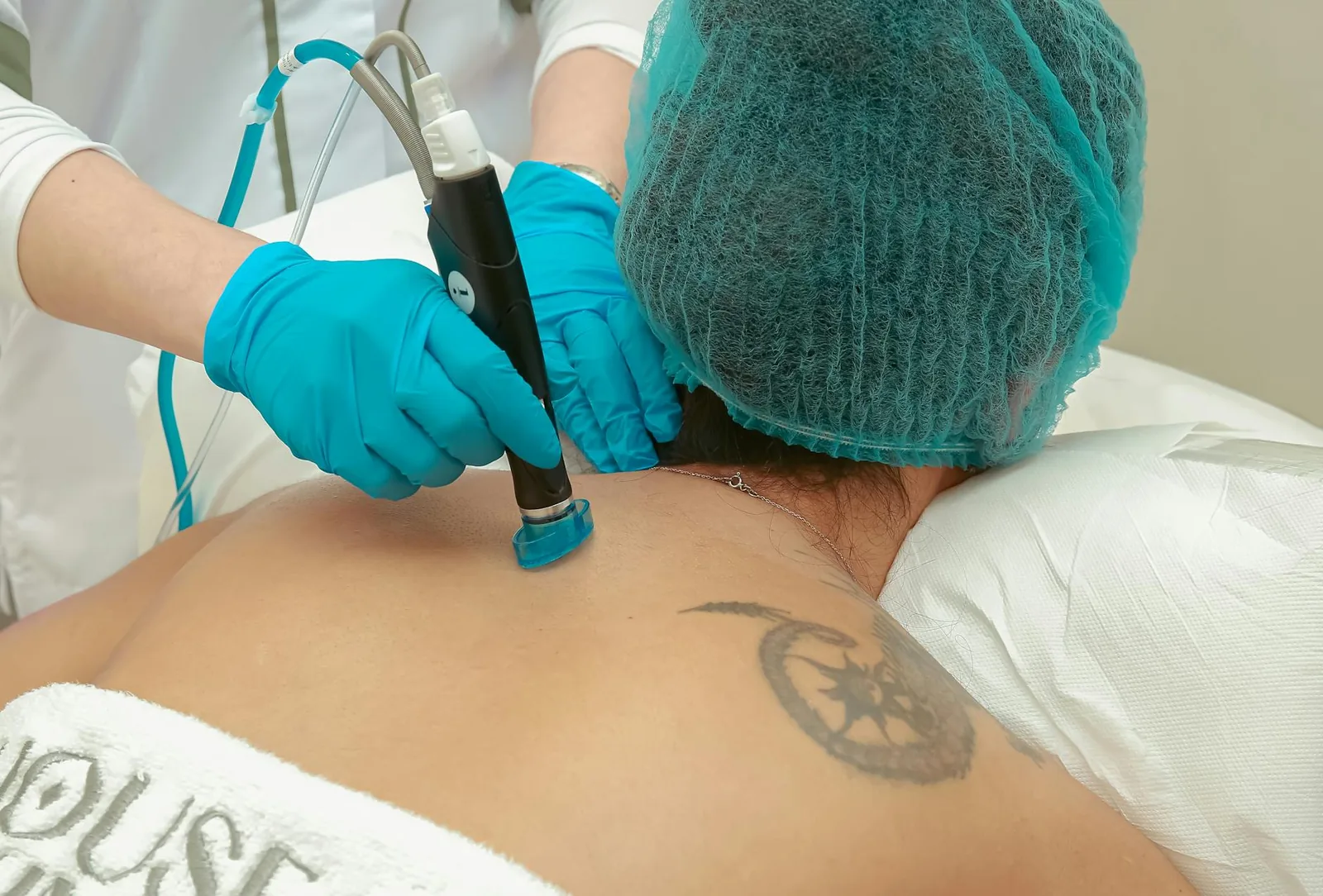 Láser para Eliminación de Tatuajes en Clínica Gottardo